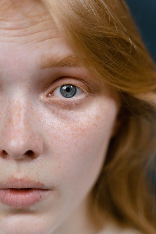 A freckled, very fair face against a teal background.